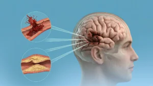 Brain Stroke