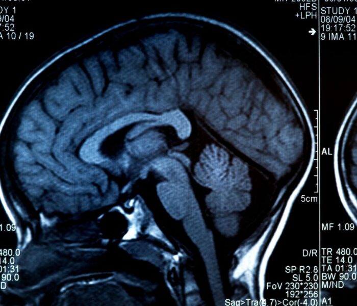 Brain Tumour Myths and Facts: What You Should Know