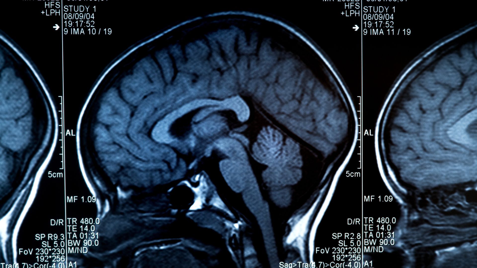 Brain Tumour Myths and Facts: What You Should Know