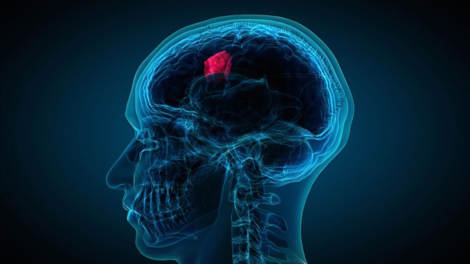 Brain Tumors